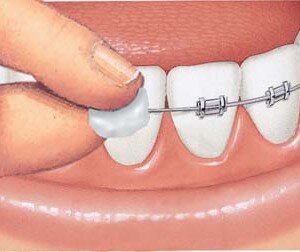 SI É STACCATO UN BRACKET DELL'APPARECCHIO - Odontoiatri associati Bologna